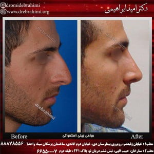 چه کسانی نیاز به جراحی بینی دارند؟