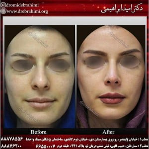 اصول جراحی رینوپلاستی چیست؟