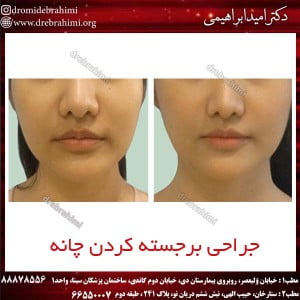 برجسته-کردن چانه