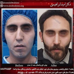 بعضی از مشکلات بینی که نیاز به عمل دارد