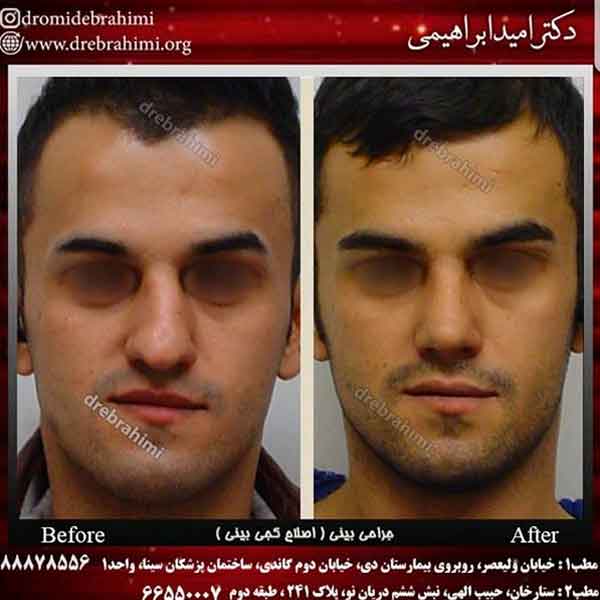 تورم طولانی بعد از جراحی بینی