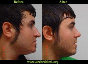 جراح بینی 10