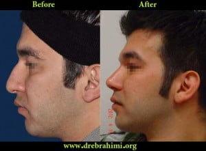 آیا جراحی بینی های گوشتی مشکل تر است؟ 