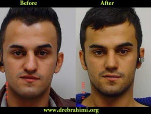 جراح بینی 11