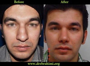 آیا جراحی بینی های گوشتی مشکل تر است؟ 