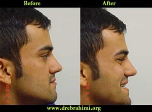 جراح بینی 12