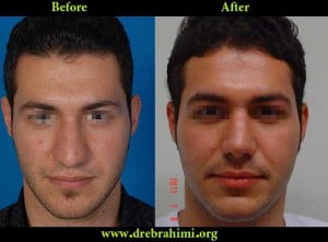 آیا جراحی بینی های گوشتی مشکل تر است؟ 