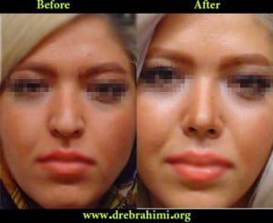 جراح بینی 13