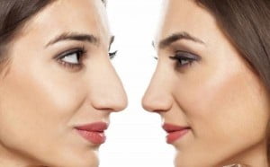 بعد از عمل جراحی بینی چطور از کبودی و تورم بکاهیم؟! 
