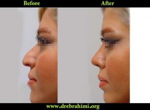 جراح بینی 14