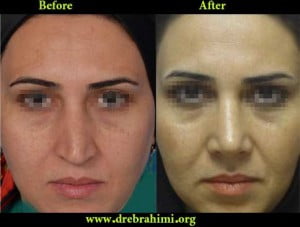 جراح بینی 15