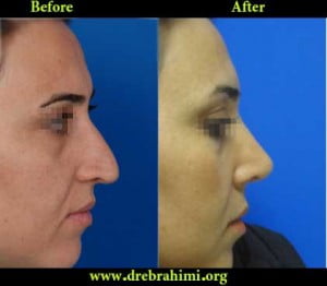 جراح بینی 16