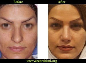 آیا جراحی بینی های گوشتی مشکل تر است؟ 