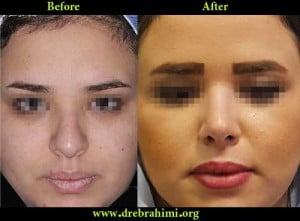 آیا جراحی بینی های گوشتی مشکل تر است؟ 