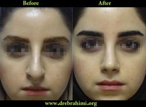 آیا جراحی بینی های گوشتی مشکل تر است؟