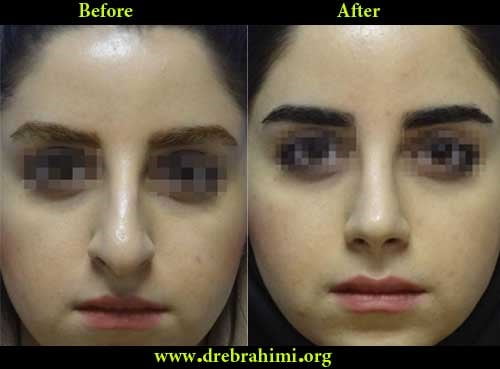 آیا جراحی بینی های گوشتی مشکل تر است؟