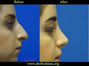 آیا جراحی بینی های گوشتی مشکل تر است؟ 