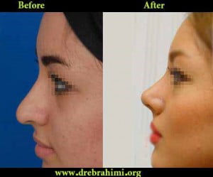 جراحی زیبایی بینی توسط دکتر امید ابراهیمی بهترین جراح بینی در تهران