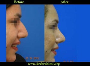 آیا جراحی بینی های گوشتی مشکل تر است؟ 