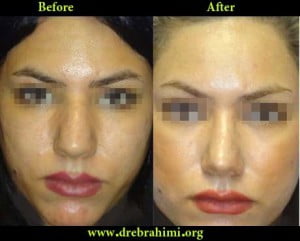 آیا جراحی بینی های گوشتی مشکل تر است؟ 