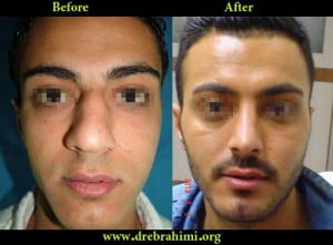 آیا جراحی بینی های گوشتی مشکل تر است؟ 