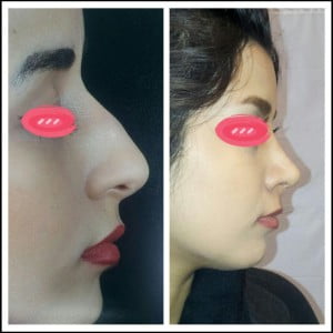 اصول جراحی رینوپلاستی چیست؟