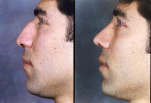 اصول جراحی رینوپلاستی چیست؟