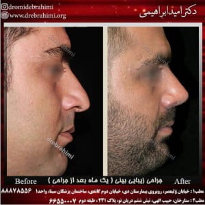 جراحی بینی طبیعی