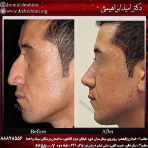 نمونه عکس قبل و بعد جراحی بینی طبیعی انجام شده توسط بهترین جراح بینی طبیعی در تهران: