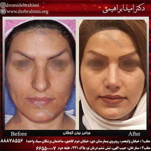 آیا جراحی بینی های گوشتی مشکل تر است؟ 