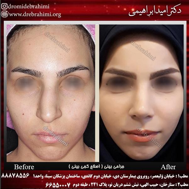دستورات بعد عمل جراحی زیبایی بینی