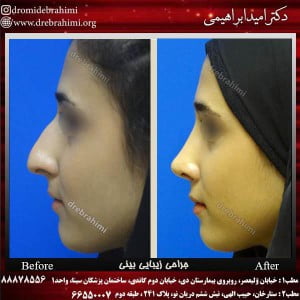 عمل بینی استخوانی