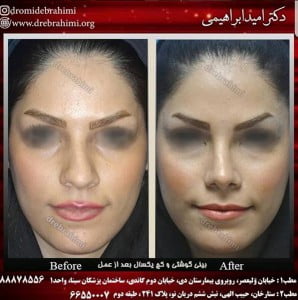عمل بینی گوشتی بهتر است یا استخوانی؟