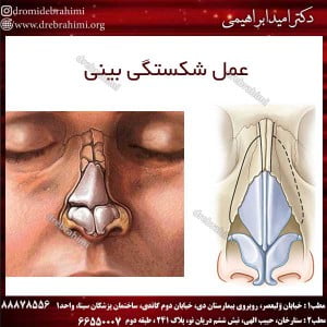 عمل شکستگی بینی