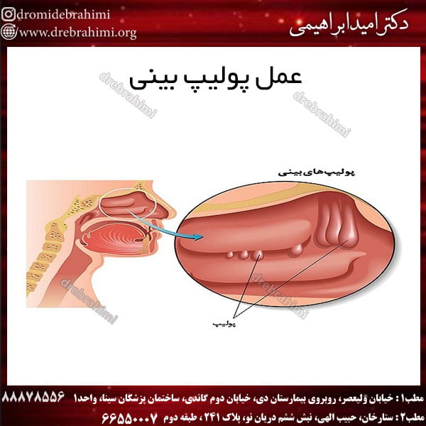 عمل پولیپ بینی