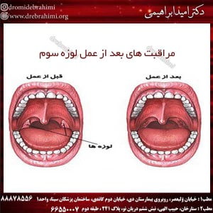 مراقبت های بعد از عمل لوزه سوم