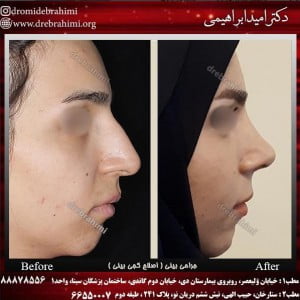 مشکل تنفسی بعد از عمل بینی درمان پذیر