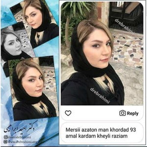 نکات مهم جراحی رینوپلاستی