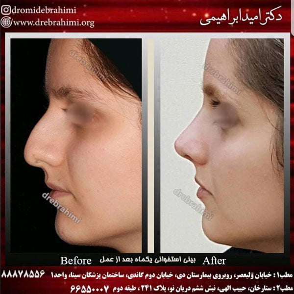 ورم بعد از جراحی بینی را چطور از بین ببریم