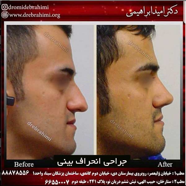 جراحی انحراف بینی