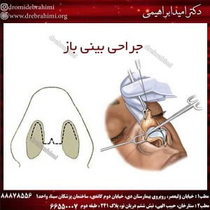 جراحی بینی باز