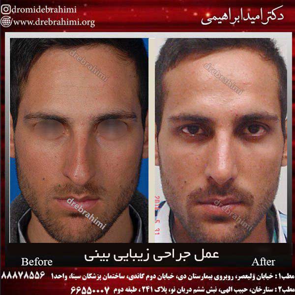 عمل جراحی زیبایی بینی