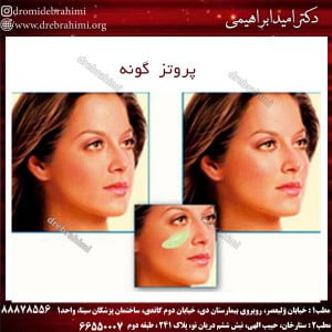 عمل کاشت پروتز گونه در تهران - دکتر ابراهیمی