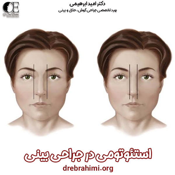 استئوتومی در جراحی بینی - دکتر ابراهیمی