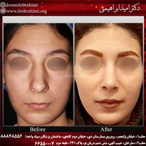 استئوتومی در جراحی بینی