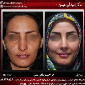 بهترین جراح بینی دکتر امید ابراهیمی