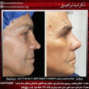 جراحی بینی ترمیمی