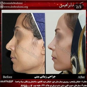 جراحی بینی ترمیمی