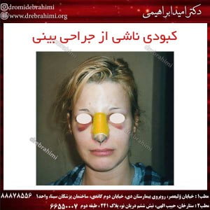 کبودی ناشی از جراحی بینی 