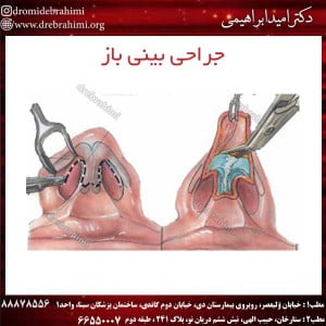 جراحی بینی باز